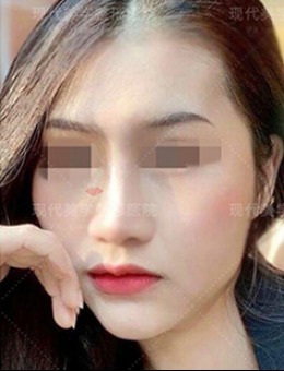 韩国现代美学轮廓整形案例分享 与“骨突脸”说拜拜！