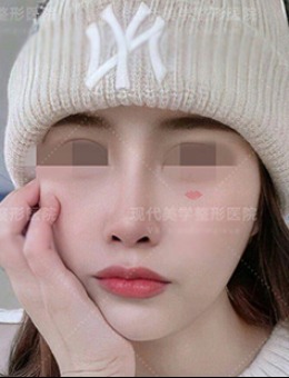 韩国现代美学轮廓整形案例分享 与“骨突脸”说拜拜！_术后