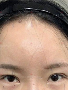 韩国现代美学气质美女养成记：额头提升+眼修复的组合变美方案！