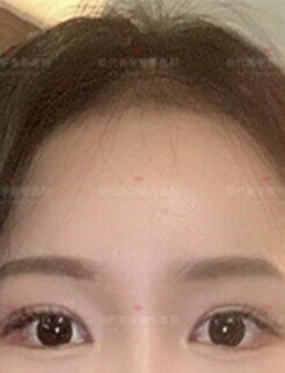 -韩国现代美学气质美女养成记：额头提升+眼修复的组合变美方案！