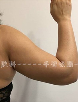 韩国Ucanb手臂吸脂+腋下吸脂前后对比照_术前