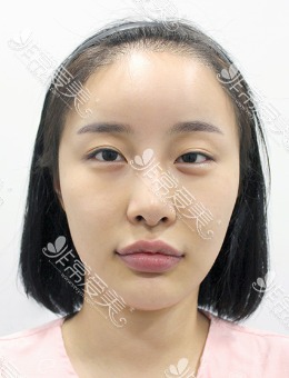 20岁女生眼皮睁眼费劲睁不开，眼提肌手术后大眼睛水汪汪惹人疼！