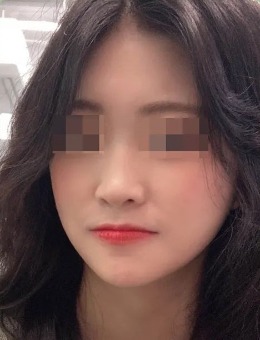 韩国4月31日整形外科隆鼻手术前后对比