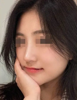 韩国4月31日整形外科隆鼻手术前后对比_术后