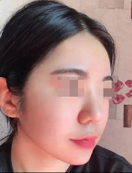 韩国4月31日整形外科鼻综合手术前后对比_术后