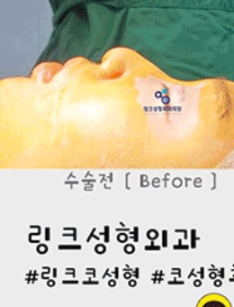 韩国林克整形短鼻延长+隆鼻手术对比照_术前