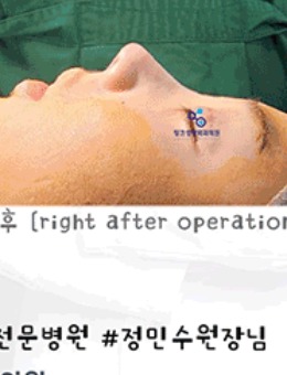 韩国林克整形短鼻延长+隆鼻手术对比照_术后