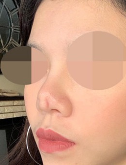 韩国4月31日整形外科鼻头挛缩修复对比图