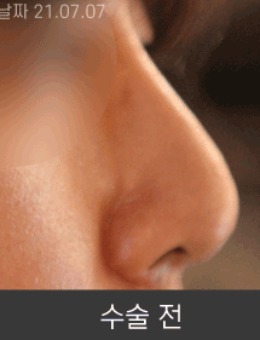 韩国清潭星整形隆鼻术后一个月恢复照片分享