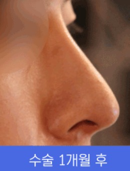 韩国清潭星整形隆鼻术后一个月恢复照片分享