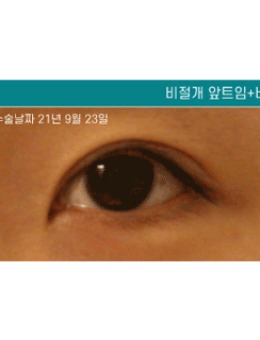 韩国清潭星非切开内眼角+上眼角综合矫正眼型对比照_术前