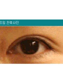 韩国清潭星非切开内眼角+上眼角综合矫正眼型对比照