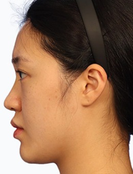 韩国林克整形水滴形韩系翘鼻尖隆鼻施术案例
