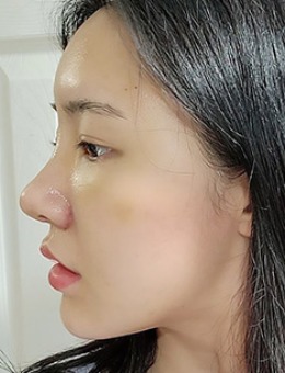 韩国林克整形水滴形韩系翘鼻尖隆鼻施术案例_术后