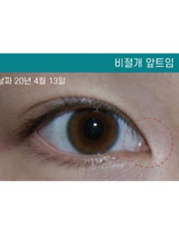 韩国清潭星整形非切开内眼角手术对比照