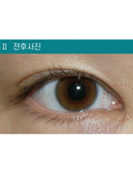 韩国清潭星整形非切开内眼角手术对比照