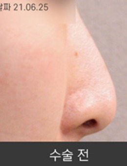 -韩国清潭星整形短鼻子隆鼻+鼻尖延长手术对比案例