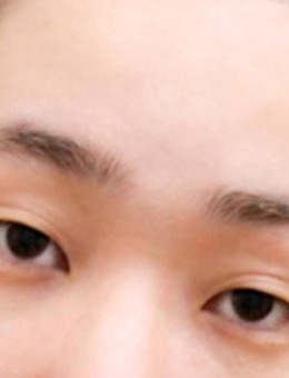 -韩国yellow整形埋线双眼皮+开眼角+眼尾下至综合改善眼型对比照