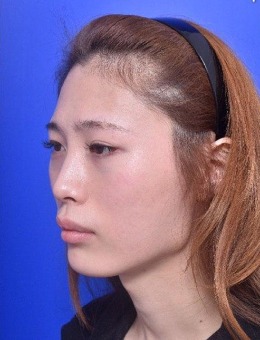 韩国VG整形外科轮廓+鼻综合前后对比