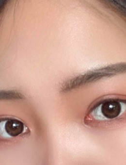 韩国yellow埋线双眼皮+开眼角手术对比照