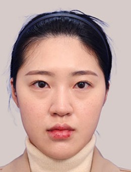 -韩国林克整形全脸脂肪填充+隆鼻+鼻翼缩小组合整形案例