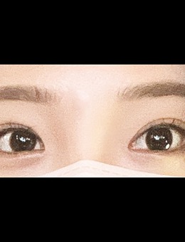 -韩国icon整形埋线法双眼皮手术对比照