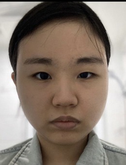 韩国VG整形外科全切双眼皮+鼻综合前后对比