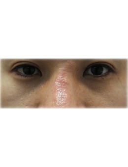 韩国疤痕修复医院鼻梁疤痕去除案例