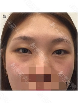 韩国UcanB整形外科埋线双眼皮+手臂吸脂前后对比照
