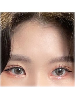 韩国Yellow整形埋线双眼皮+上眼角整形对比，变美就是这么简单！_术前