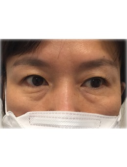 韩国去眼袋哪家医院好？UcanB整形外科外切去眼袋对比超明显！_术前
