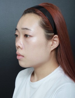 韩国VG百利酷整形外科鼻综合前后对比