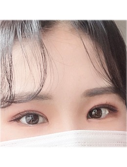 -韩国埋线双眼皮手术推荐Yellow整形,附上真人埋线双眼皮对比照！