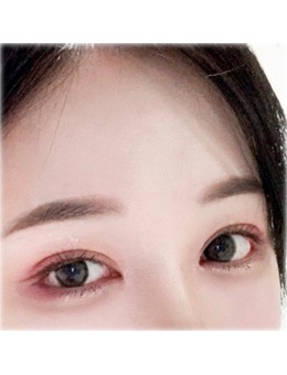 -韩国Yellow整形外科埋线+上眼角+提肌+后眼角下至手术前后对比照