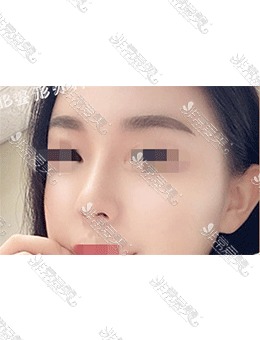 韩国Ucanb整形医院隆鼻案例图，精致小翘鼻太美了！