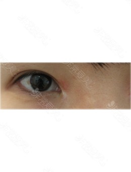 韩国鸣玉轩韩医院修复内眼角疤痕+色素沉淀的对比也太明显了吧！_术前