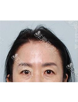 韩国ZELL整形外科内视镜额头提升对比照_术前