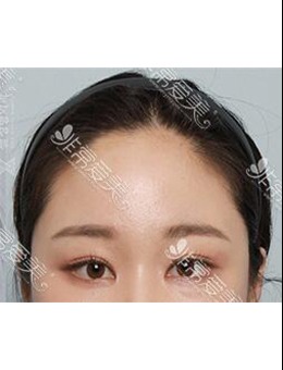 韩国ZELL整形外科额头提升+双眼皮修复对比图