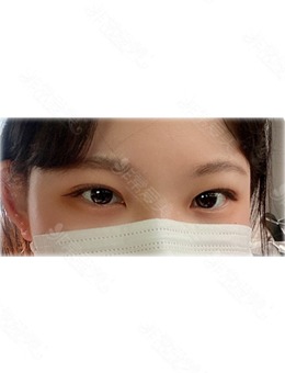 -韩国做双眼皮好的医院就有UcanB整形外科！