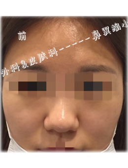 -韩国做鼻翼缩小手术推荐韩国UcanB整形外科，前后对比效果图超明显！