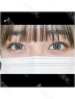 韩国眼型矫正手术中ICON整形医院确实是值得推荐！_术后