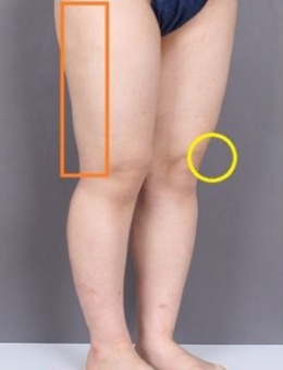 韩国365mc医院大腿吸脂修复案例分享 九年的凹凸不平终于解决了