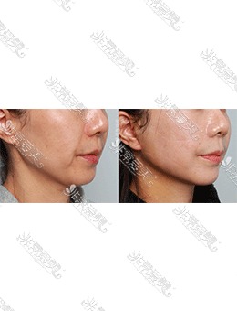 韩国迷你拉皮术后一周，法令纹鼻唇沟都不见了！