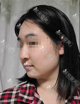 在韩国koko整形医院做了驼峰鼻矫正，术后拥有小巧精致美鼻！