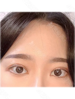 在韩国yellow做埋线双眼皮手术很满意，双眼皮不对称的问题解决了！