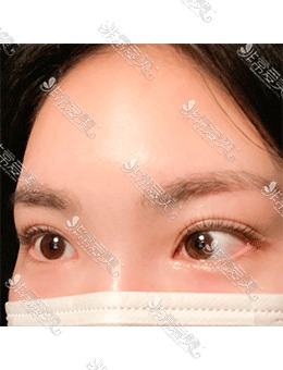 切割双眼皮+提肌右侧术后美极了，韩国yellow整形医院值得种草！