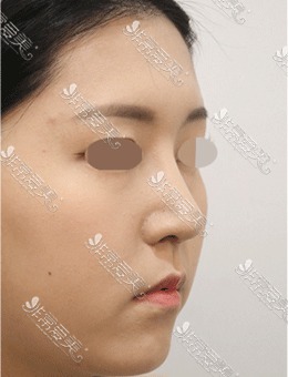 鼻部矫正真人日记对比图，韩国星整形做的鼻子太精致了！_术后