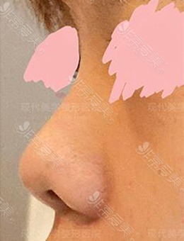 韩国现代美学整形医院鼻梁+鼻尖+鼻小柱手术，前后像变了个人！_术前
