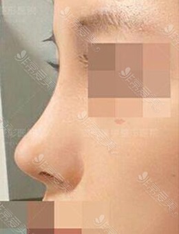 韩国现代美学整形医院鼻梁+鼻尖+鼻小柱手术，前后像变了个人！_术后