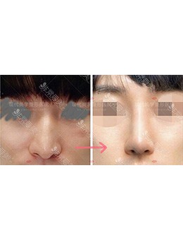 韩国现代美学整形医院男士鼻综合整形，术前术后判若两人！_术前